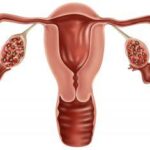 PCOS 6Tips | Eat Clean, Feel Strong, Stay Balanced