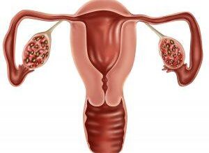 PCOS 6Tips | Eat Clean, Feel Strong, Stay Balanced