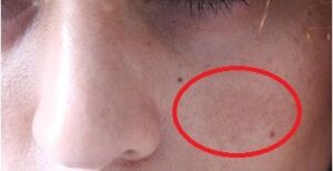 Skin Pigmentation