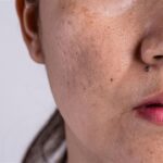 Skin Pigmentation 7Solutions for Radiant Glow