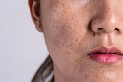 Skin Pigmentation 7Solutions for Radiant Glow