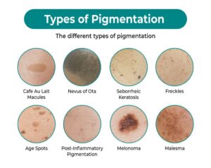 Type of Skin Pigmentation