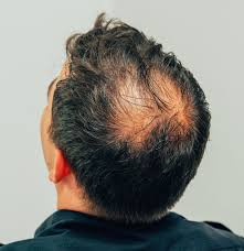 Alopecia Areata