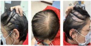 Genetic Hair Loss (Androgenetic Alopecia)