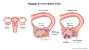 PCOS