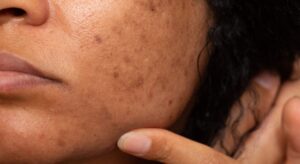 Dark Spots